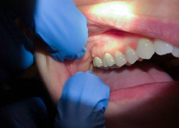 Best Knocked-Out Tooth (Avulsed Tooth) Treatment in Wynne, AR
